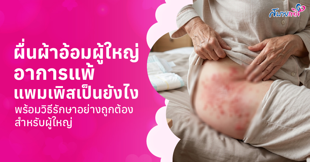 ผื่นผ้าอ้อมผู้ใหญ่ คืออะไร